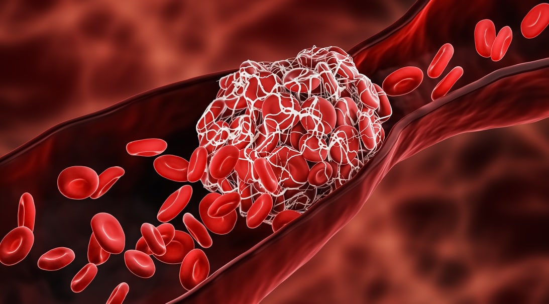6 Facts About Deep Vein Thrombosis