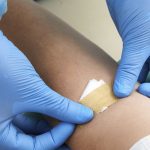 Gloved hands putting on band aid after treating hemochromatosis with phlebotomies