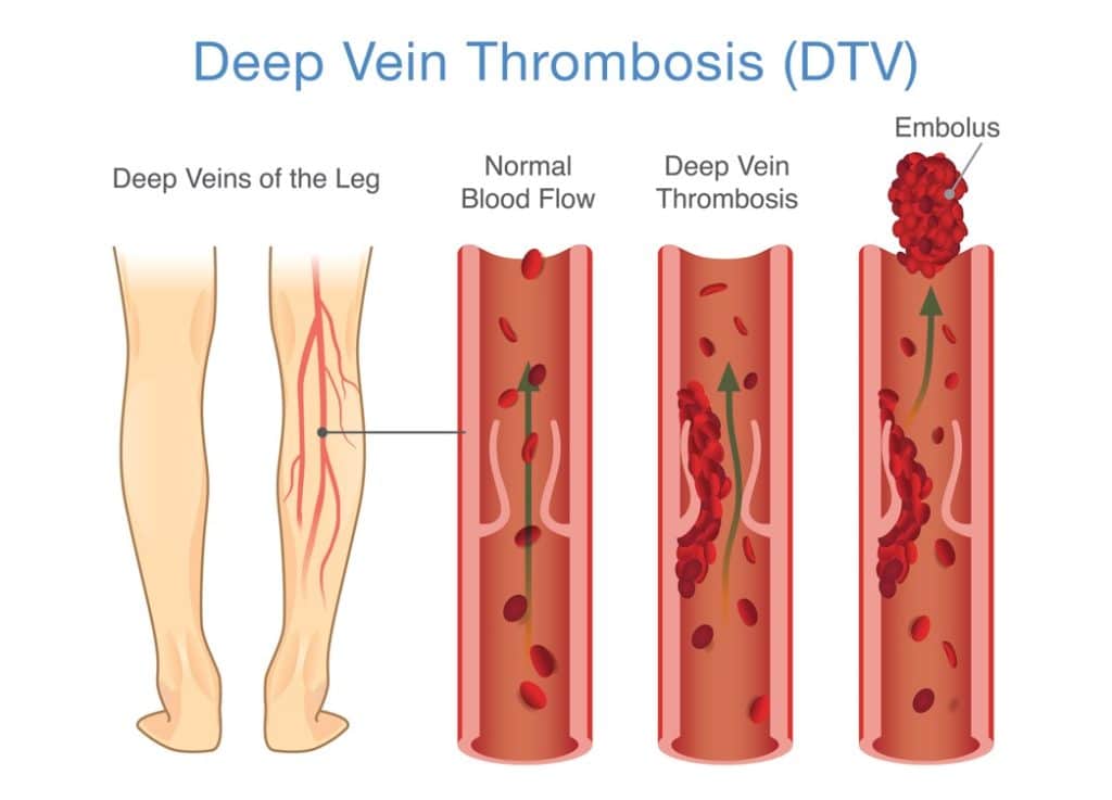 Illustrations explaining deep vein thrombosis