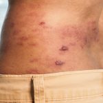 patient with shingles rash on torso in need of shingles treatment