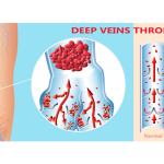 Illustration of blood vessels in leg with deep vein thrombosis for the discussion of when to see a hematologist for blood clots