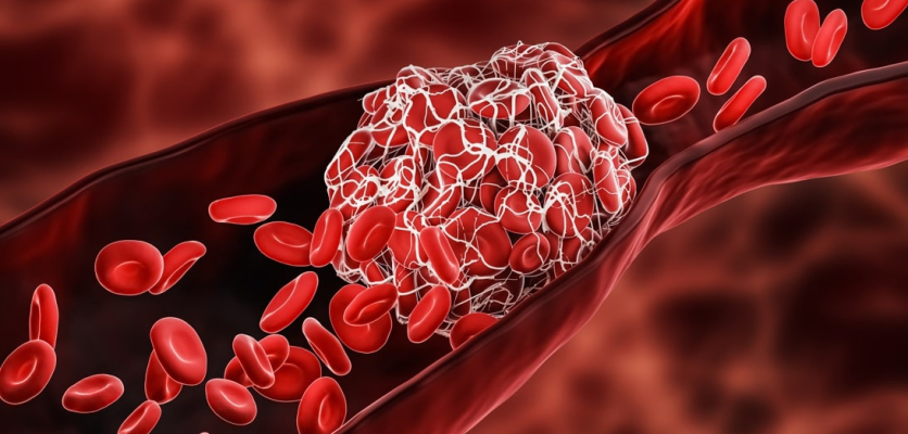 6 Facts About Deep Vein Thrombosis