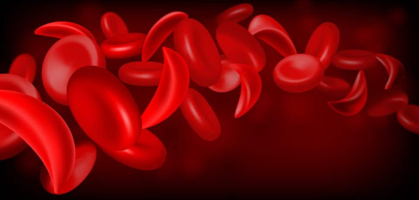 Sickle Cell Anemia Treatments and Tips