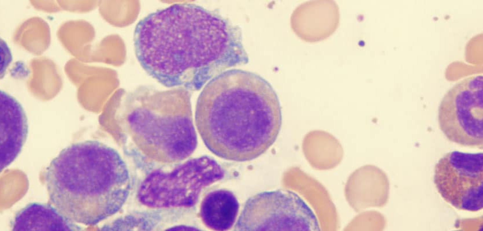 What is Myelodysplastic Syndrome? - Personalized Hematology-Oncology